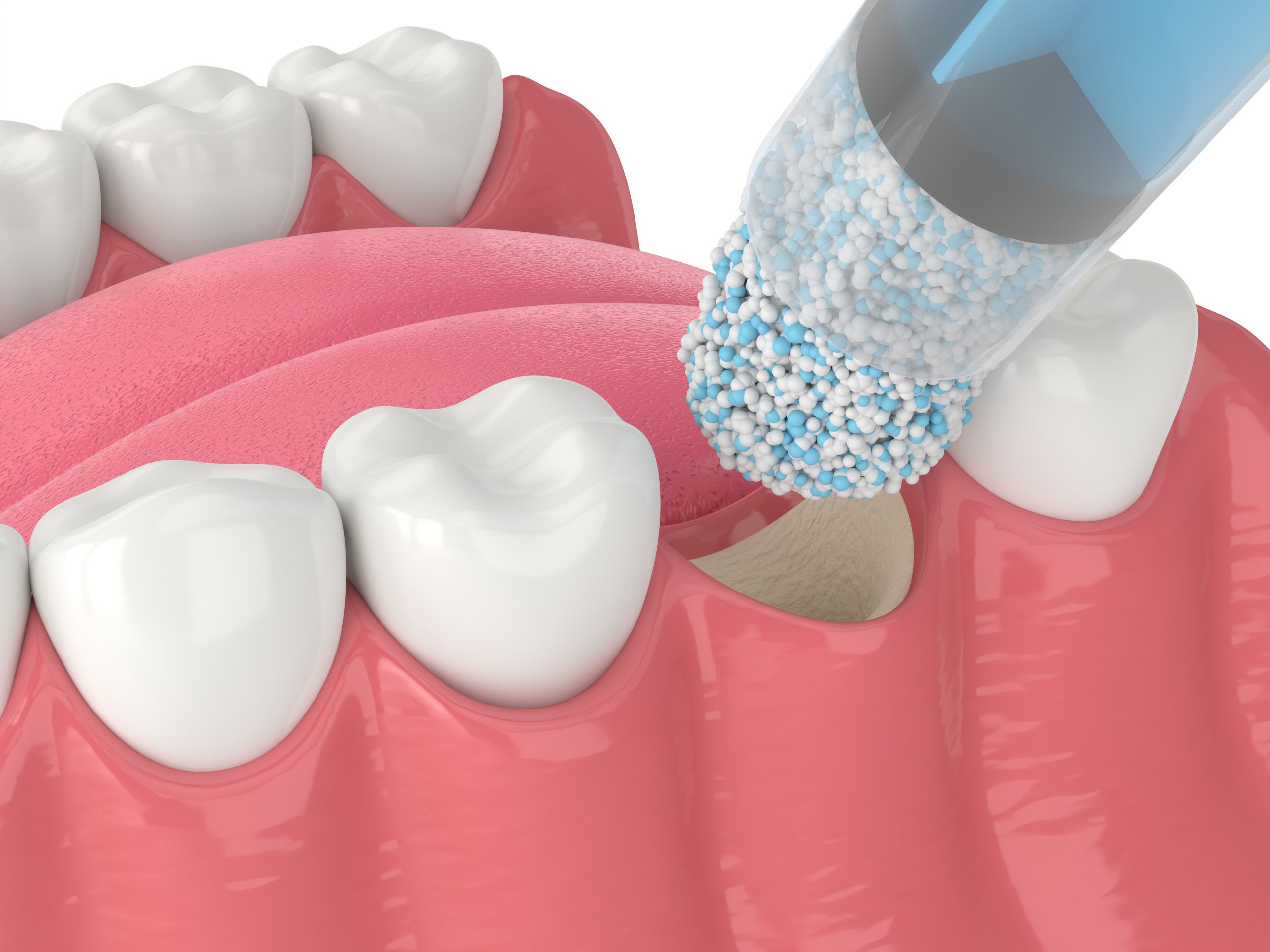 3D render of dental bone grafting with dental bone biomaterial a