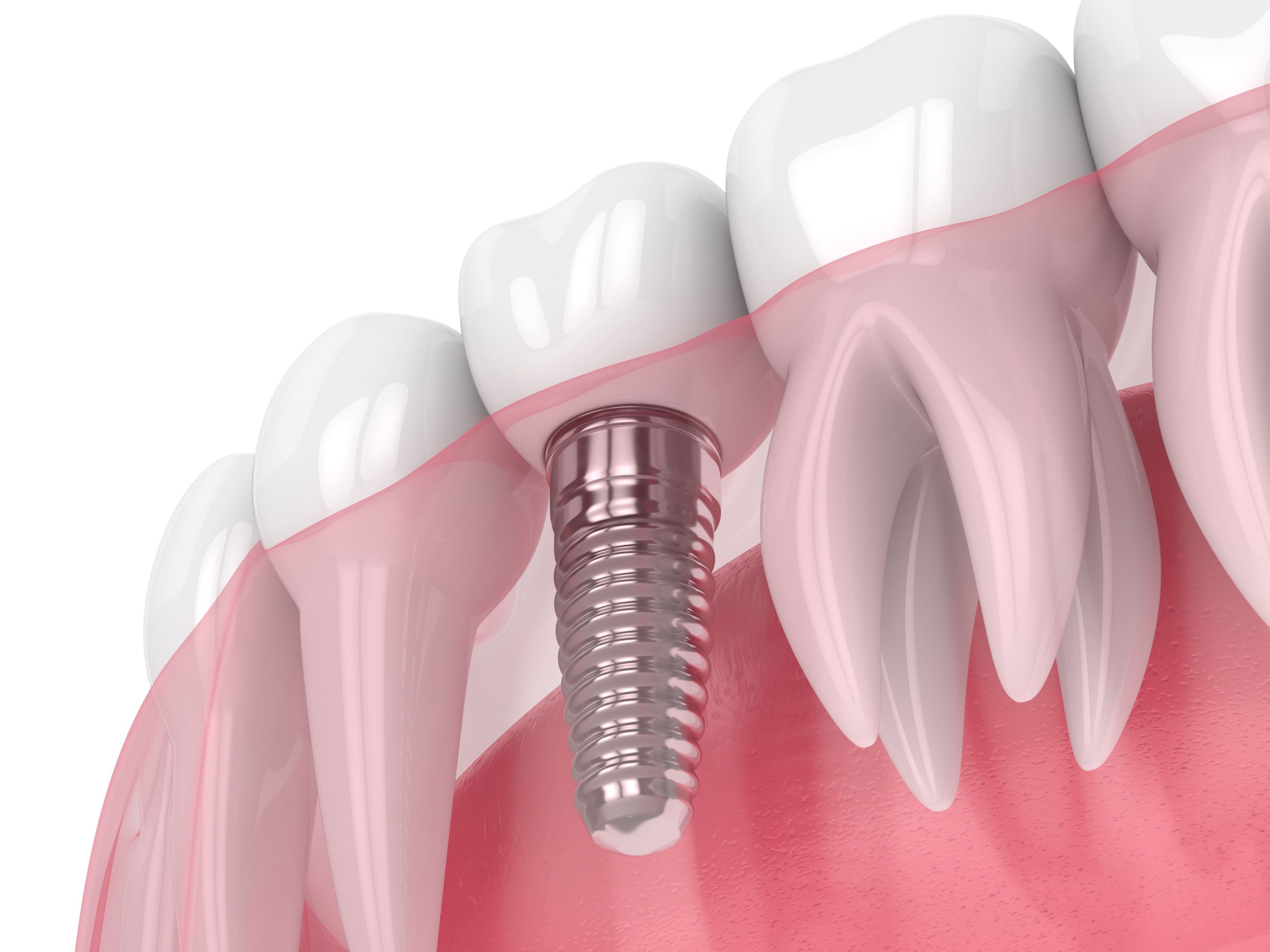 Dental Implants-min